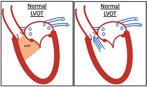 what is lvot in cardiology